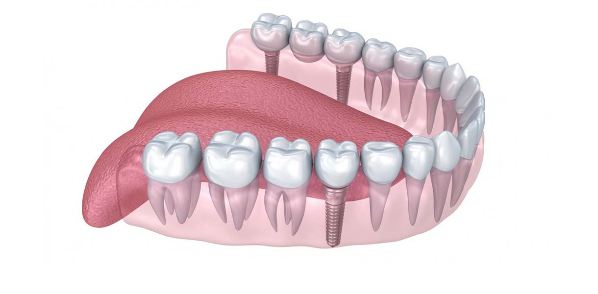 Bone Grafting by Dr. Aparna Khamatkar