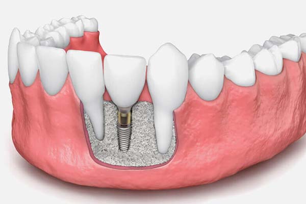 Common Myths about Bone Loss