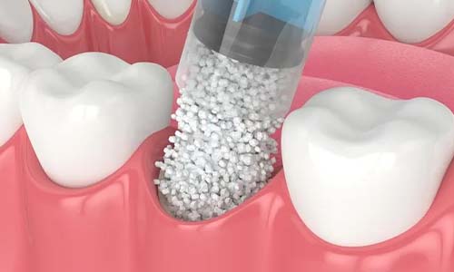 Bone Grafting process