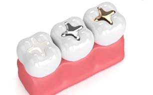 Cavity Prevention - Benefits of Dental Sealants