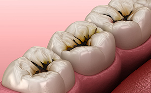 Reduced Cavity Risk - Benefits of Fluoride Treatments