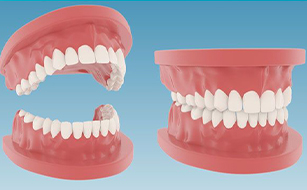 Improved Chewing Function - Benefits of Dentures