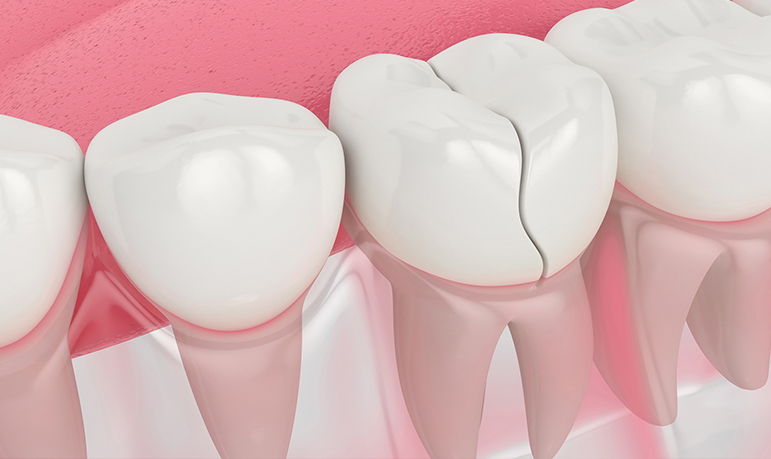 Cracked or Fractured Teeth - Signs You Might Need Inlays and Onlays