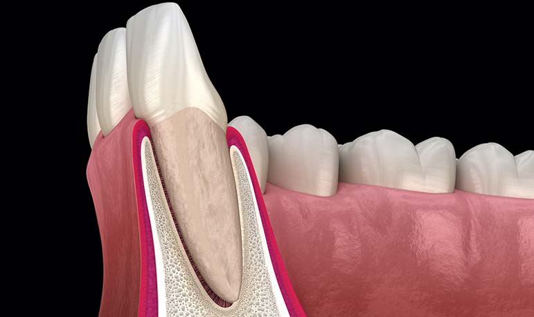 Deep Gum Pockets- Pocket Reduction Surgery