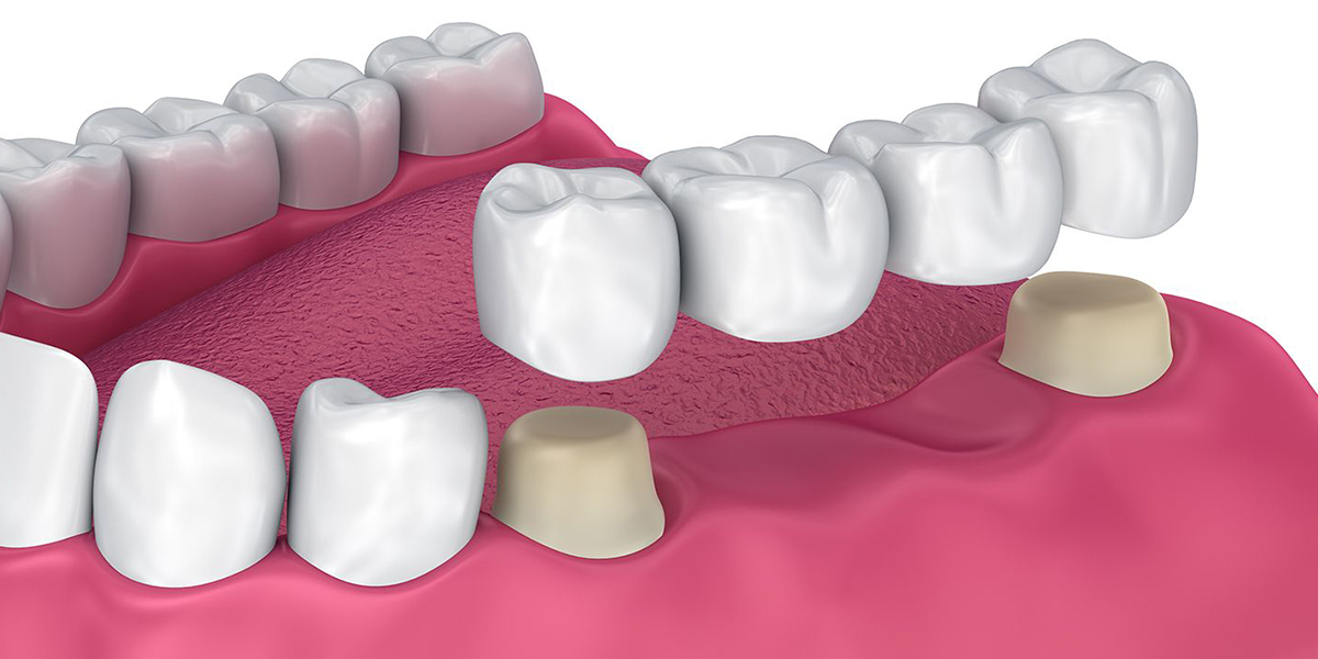 Dental Bridges by Dr. Aparna Khamatkar