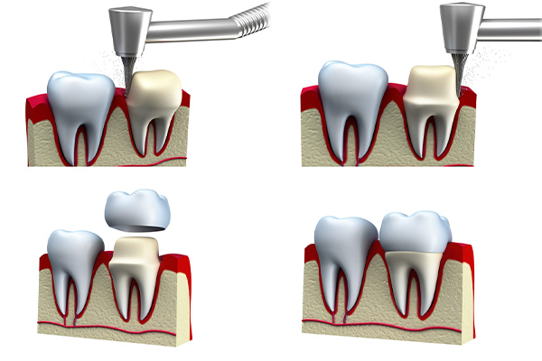 The Dental Crown Process