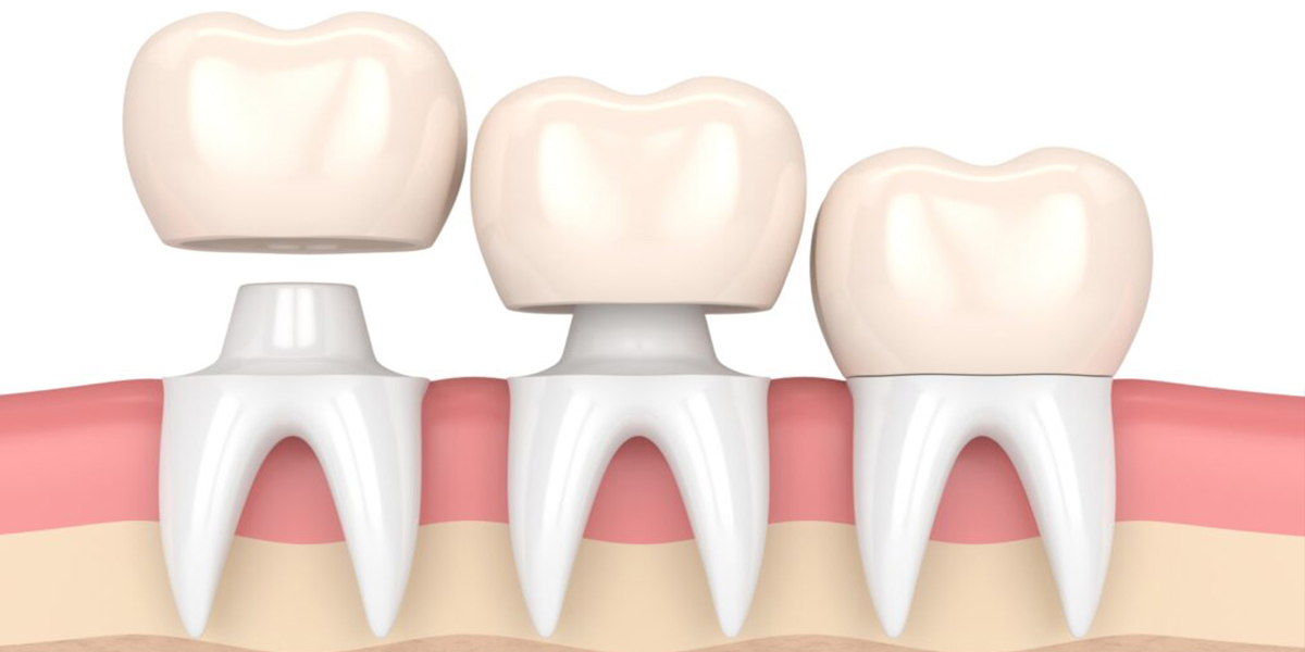 Dental Crowns by Dr. Aparna Khamatkar