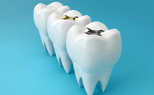 Durability - Benefits of Dental Crowns