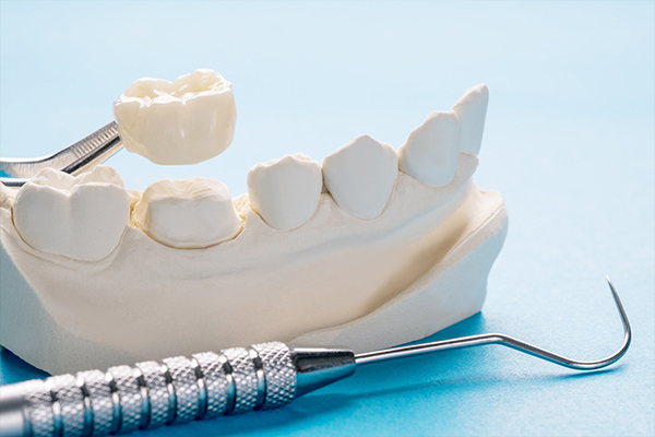 Common Myths about Dental Crowns