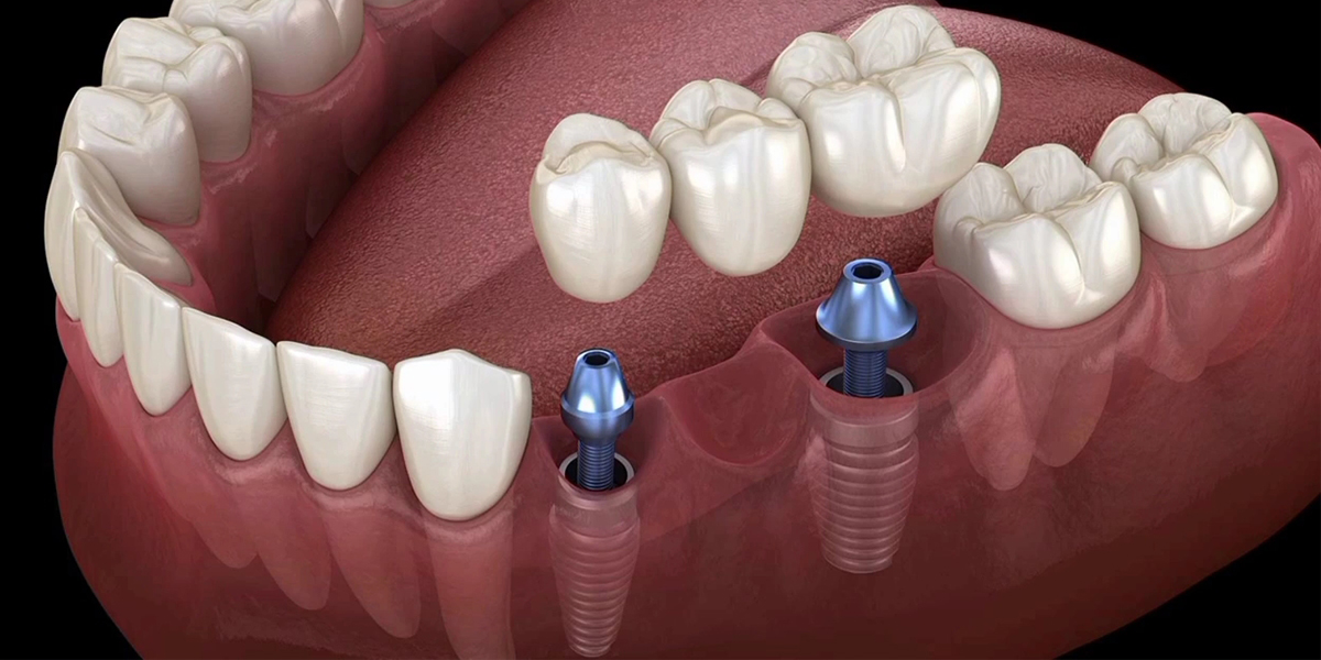 Dental Implants by Dr. Aparna Khamatkar