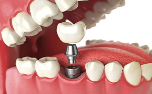 Improved Functionality - Benefits of Dental Implants