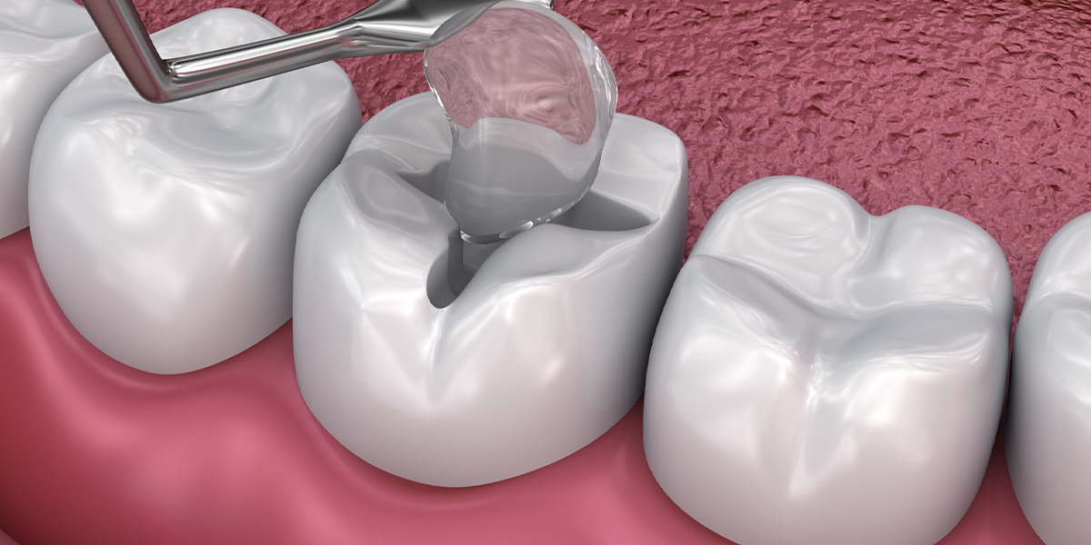 Dental Sealants by Dr. Aparna Khamatkar