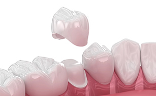 Durability - Benefits of Dental Crowns