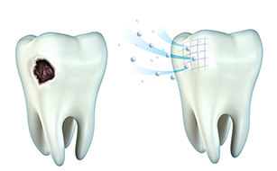 Enhanced Enamel Strength - Benefits of Fluoride Treatments