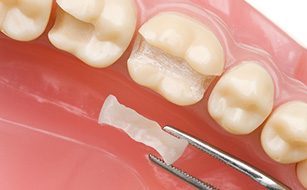 Enhanced Fit - Benefits of Dental Crowns