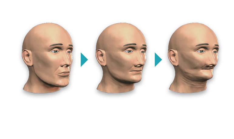 Facial Collapse - Bone Grafting