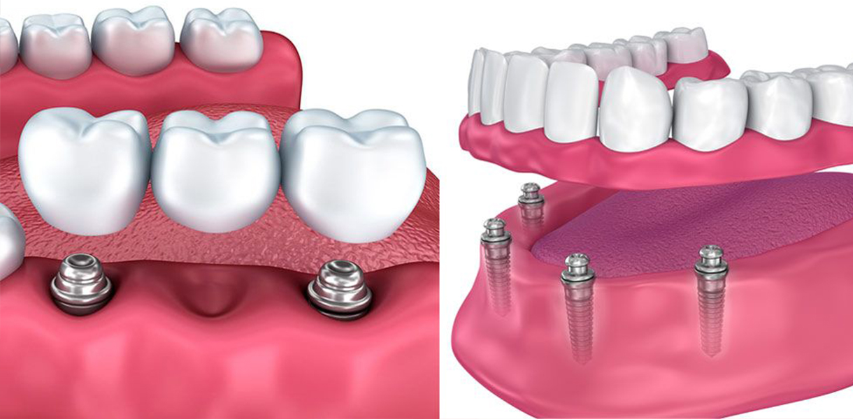 Full Mouth Reconstruction by Dr. Aparna Khamatkar