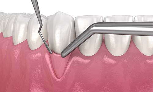 Gum Grafting Process