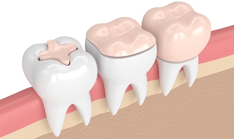 Inlays and Onlays by Dr. Aparna Khamatkar