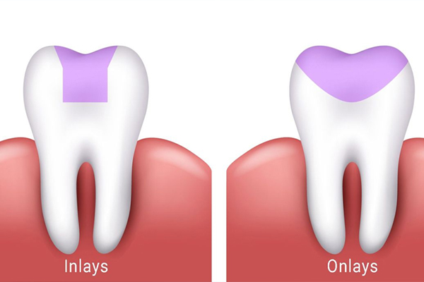 Common Myths about Inlays and Onlays