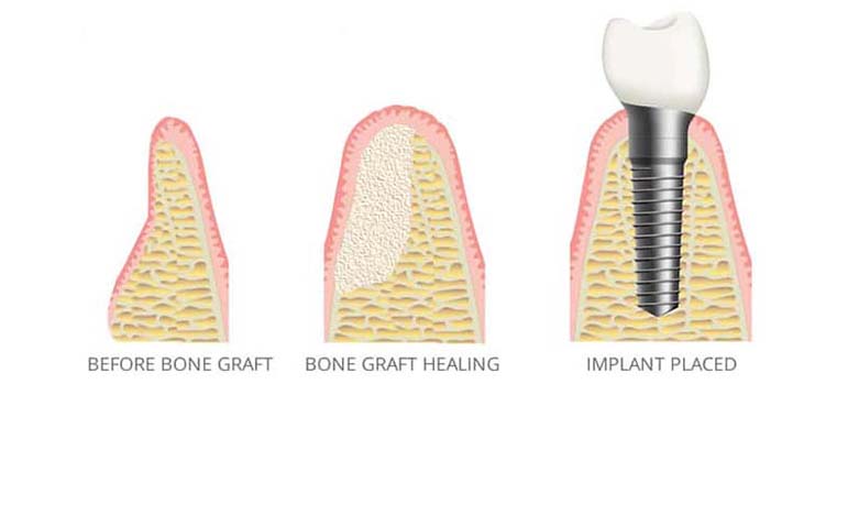 Insufficient Bone for Implants - Bone Grafting