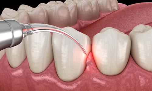 Laser Therapy process