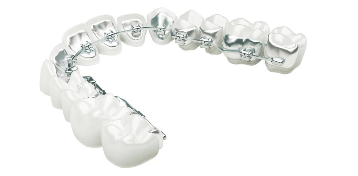 Lingual Braces by Dr. Aparna Khamatkar