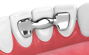 Long-term Solution - Benefits of Dental Bridges