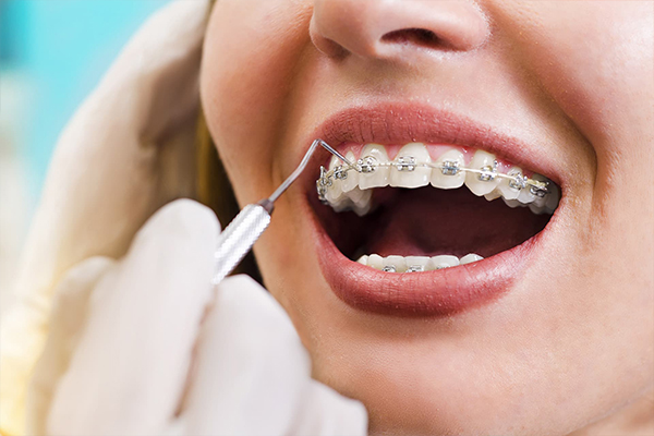 Preparing for Your Orthodontic Treatment