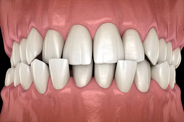 Common Orthodontic Issues Addressed