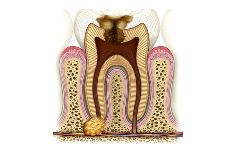 Moderate Tooth Decay - Signs You Might Need Inlays and Onlays