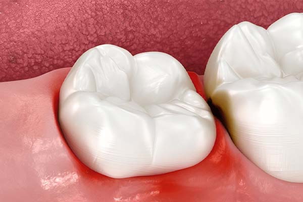 Common Myths about Gum Disease