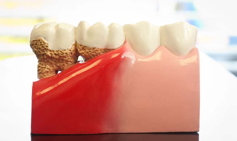 Periodontal Disease - Bone Grafting