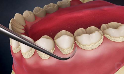 periodontal-maintenance