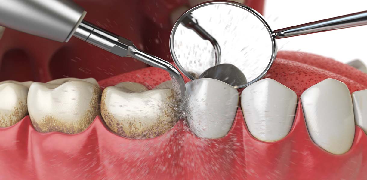  Periodontal Maintenance by Dr. Aparna Khamatkar