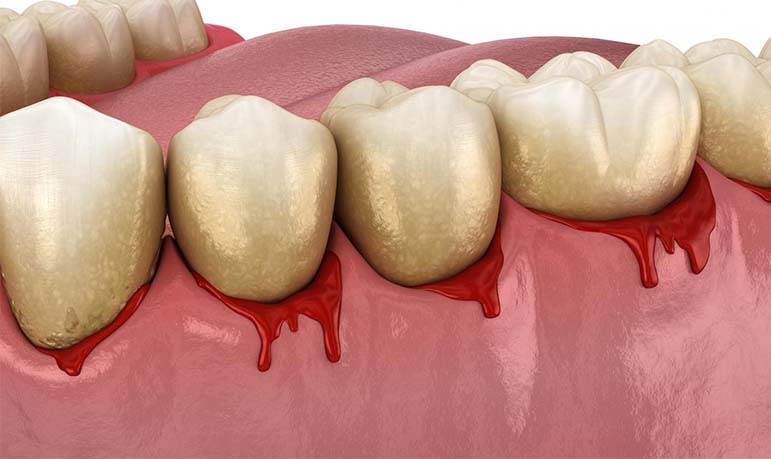 Receding Gums-Periodontal Maintenance