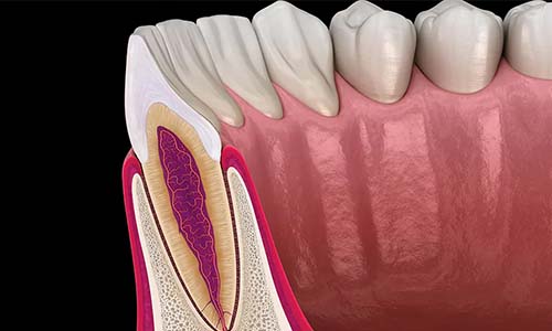 pocket-reduction-surgery-process