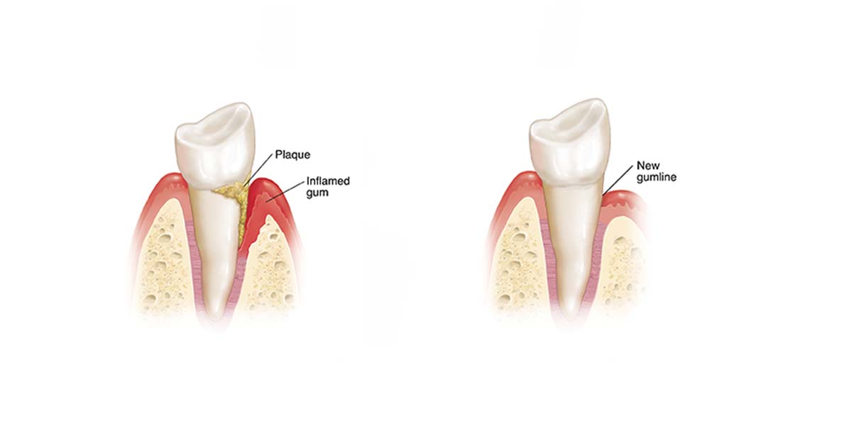 Pocket Reduction Surgery - by Dr. Aparna Khamatkar