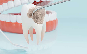 Prevention of Infection - Benefits of Tooth Extractions