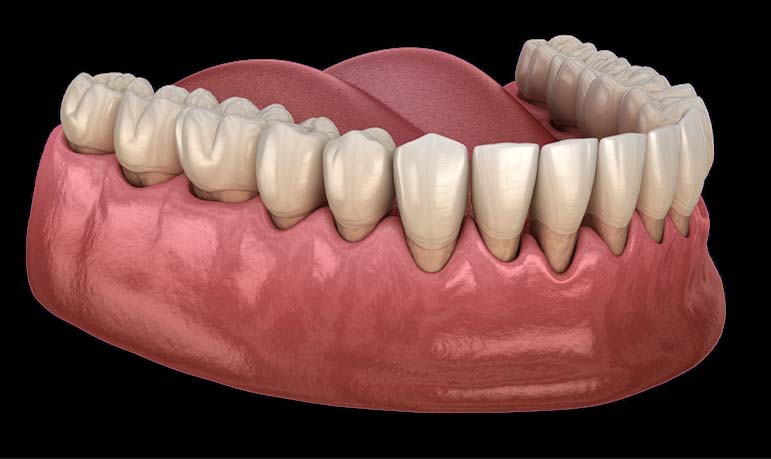 Receding Gums-Scaling and Root Planing