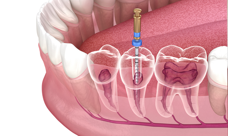 Root Canal Treatment - Signs You Might Need a Dental Crown