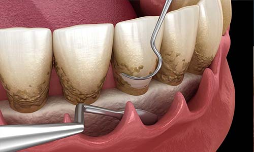 Root Planing by Dr. Aparna Khamatkar