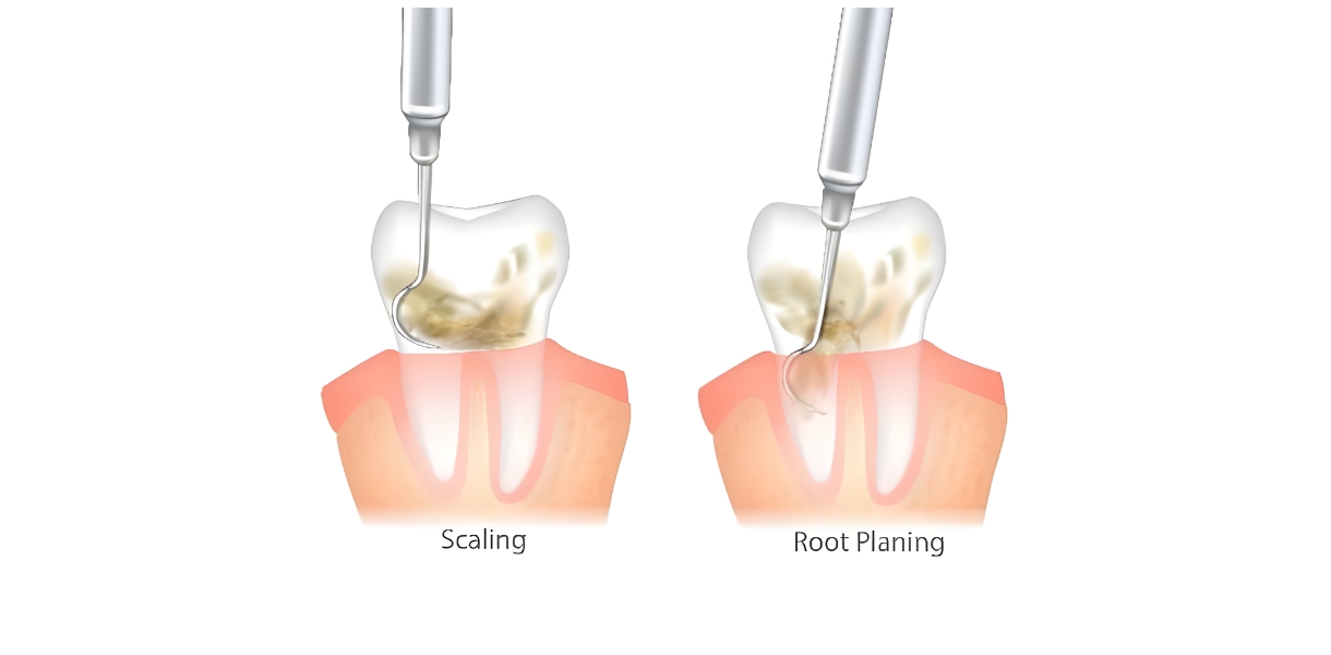 Scaling and Root Planing by Dr. Aparna Khamatkar