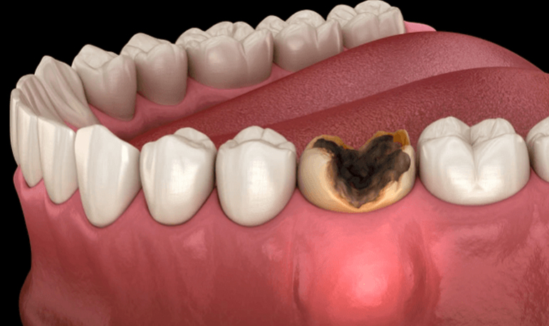 Severe Tooth Decay - Signs You Might Need a Dental Crown