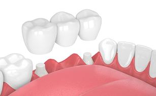 Prevention of Teeth Shifting - Benefits of Dental Bridges