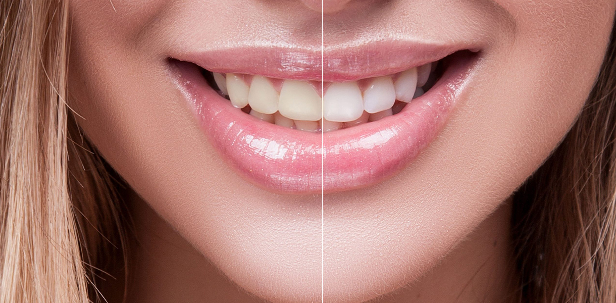 Teeth Whitening by Dr. Aparna Khamatkar