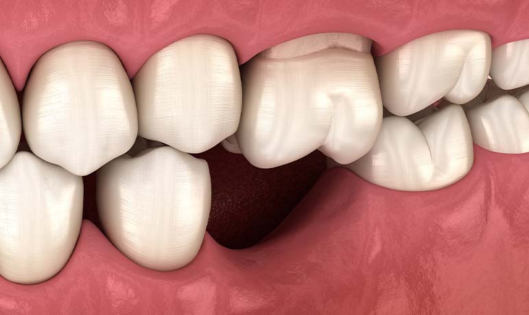 Tooth Loss - Bone Grafting