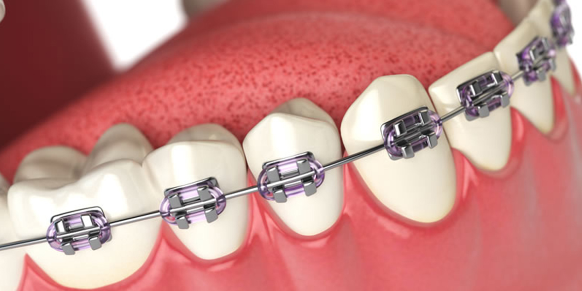 Traditional Metal Braces by Dr. Aparna Khamatkar