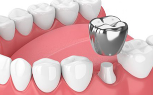 Versatility - Benefits of Dental Crowns